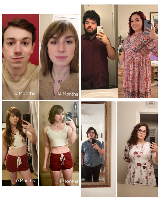 Bodily changes for MTF transgenders from feminizing hormones